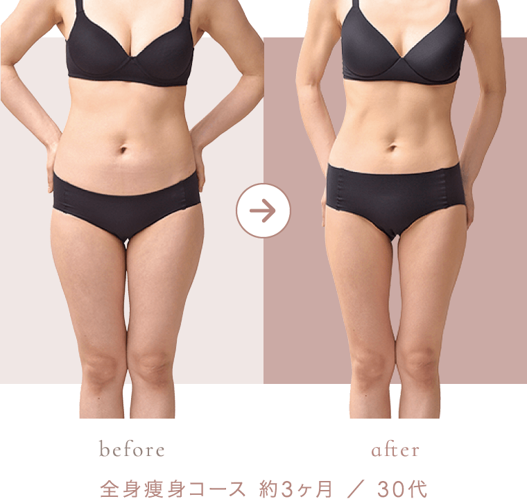 全身痩身コース 約3ヶ月 ／ 30代 のビフォーアフター