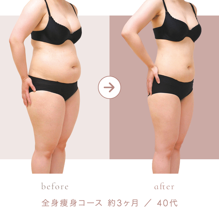 全身痩身コース 約3ヶ月 ／ 40代 のビフォーアフター